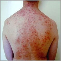 allergic skin rash