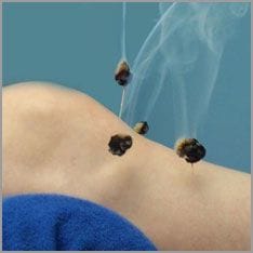 Moxa cone on the skin