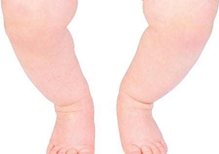 O-legs