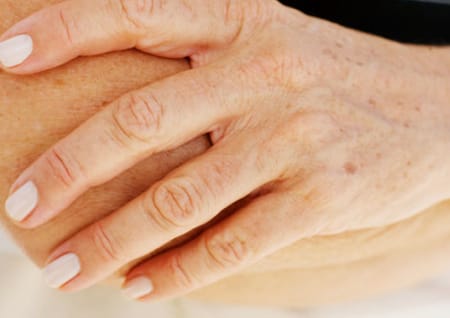 Altersflecken auf der Hand