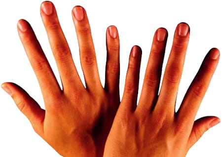Arthritis Hände