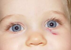 Baby with a black eye