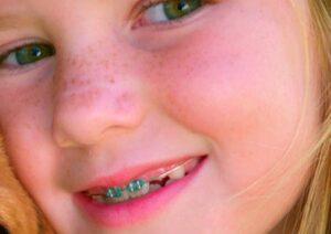 Child with braces