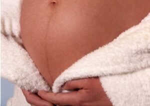 Fever in pregnancy
