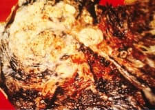 Lung cancer