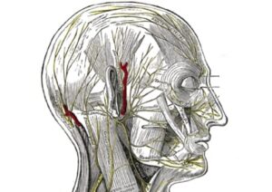 Headache
