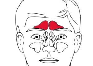 Sinusitis
