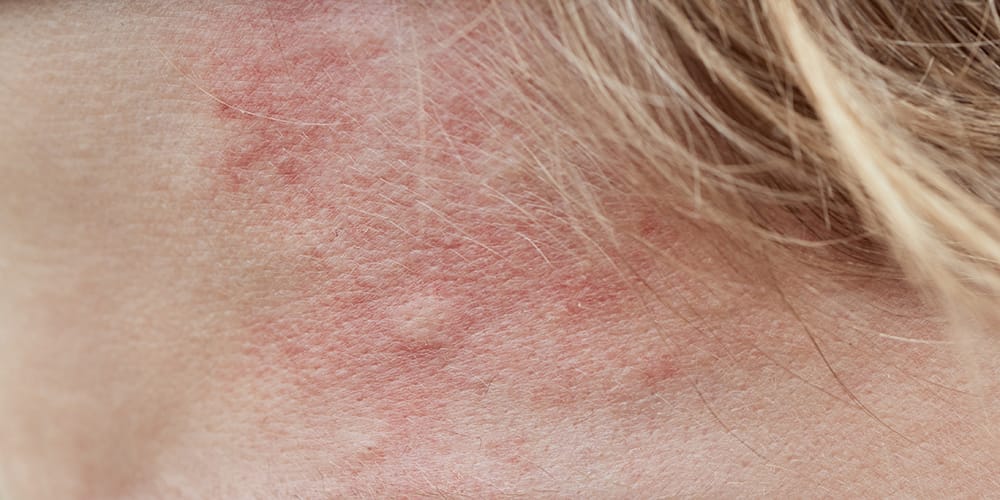Bed bugs skin irritation