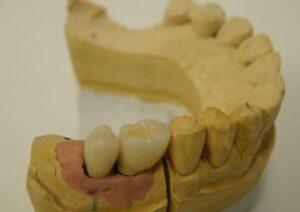Dental implant