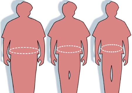 Stomach reduction