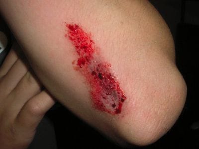 Abrasion