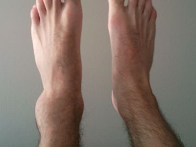sprained foot